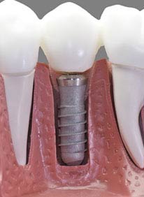 Dental Implant 
