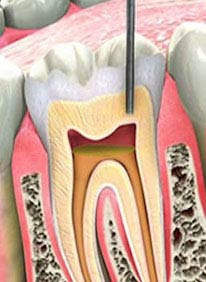 Root Canal Treatment
